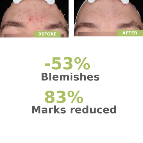A-derma Biology AC Night Peel Anti-Blemish Serum