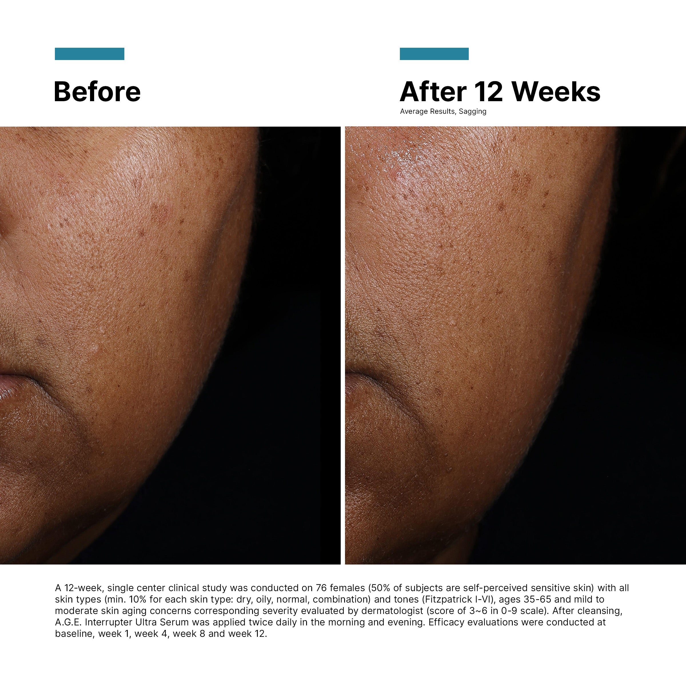 SkinCeuticals A.G.E Interrupter Ultra Skin Lifting & Tightening Serum 30ml