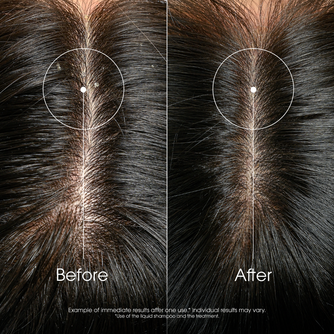 Klorane Anti-dandruff Treatment and Rebalancing Shampoo 400ml