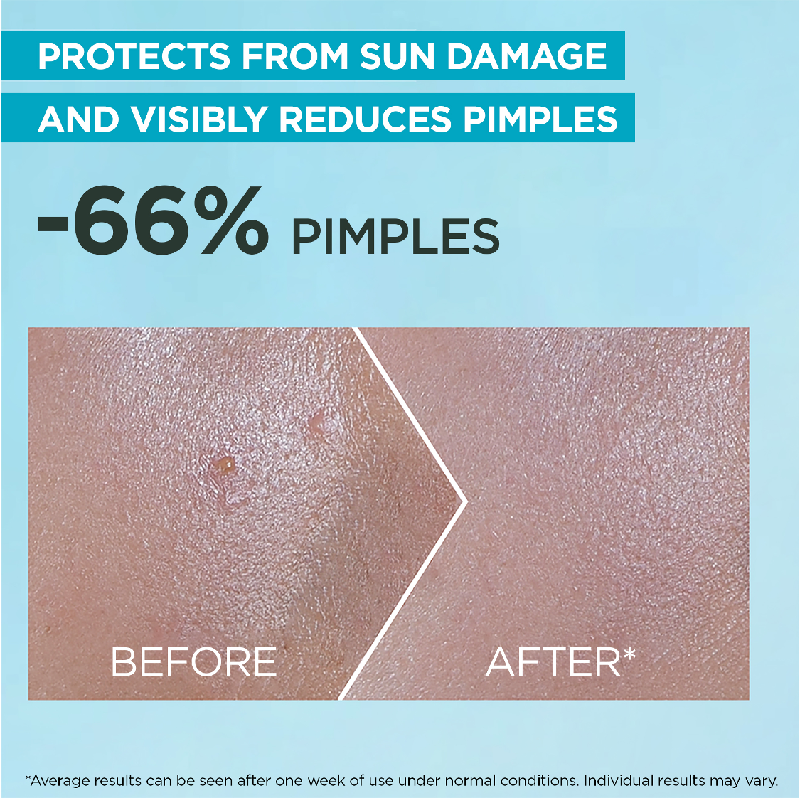 Garnier-Skin Active- SuperUV Anti-Acne SPF50+ Sunscreen 30ml – 12H Oil Control