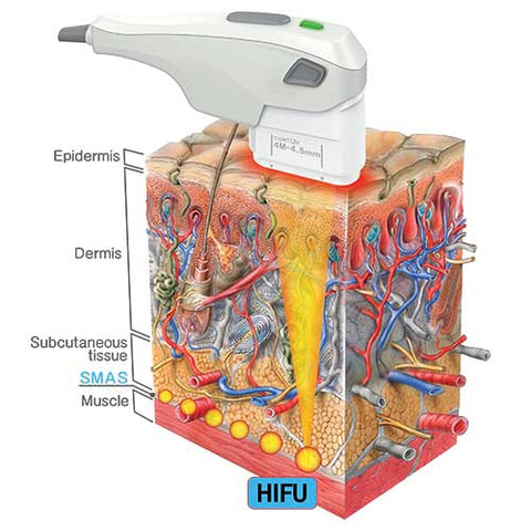 HIFU (High Intensity Focused Ultrasound)