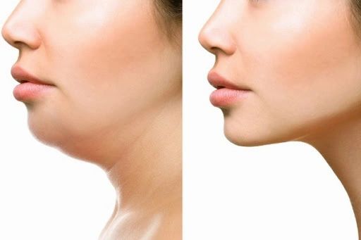Double Chin Dissolution